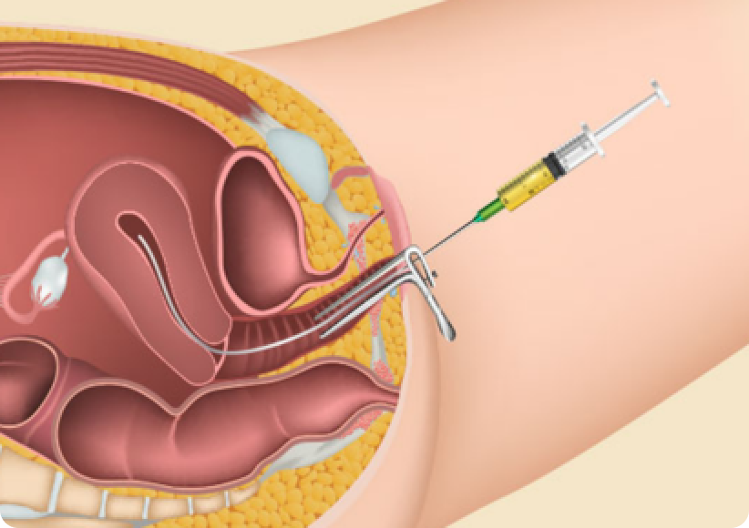 Embryo Transfer