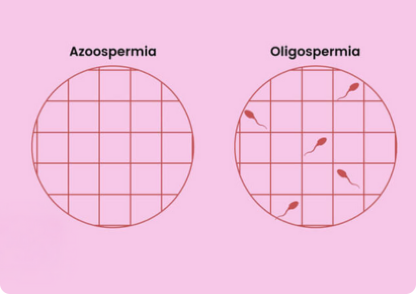Oligozoospermia and Azoospermia